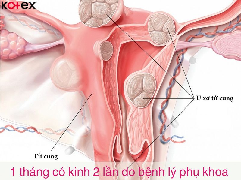 1 tháng có kinh 2 lần có thể là dấu hiệu của các bệnh lý phụ khoa nguy hiểm