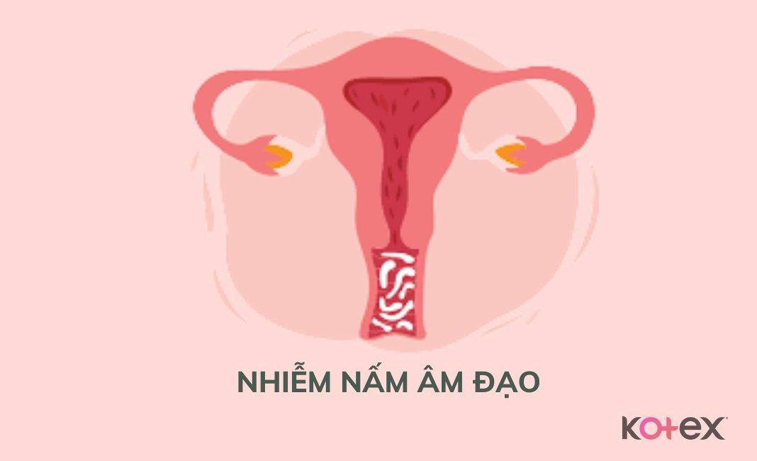 Nhiễm nấm âm đạo