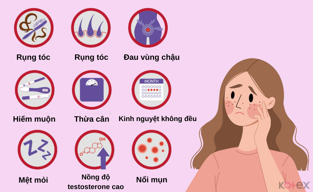 9 triệu chứng bệnh buồng trứng đa nang