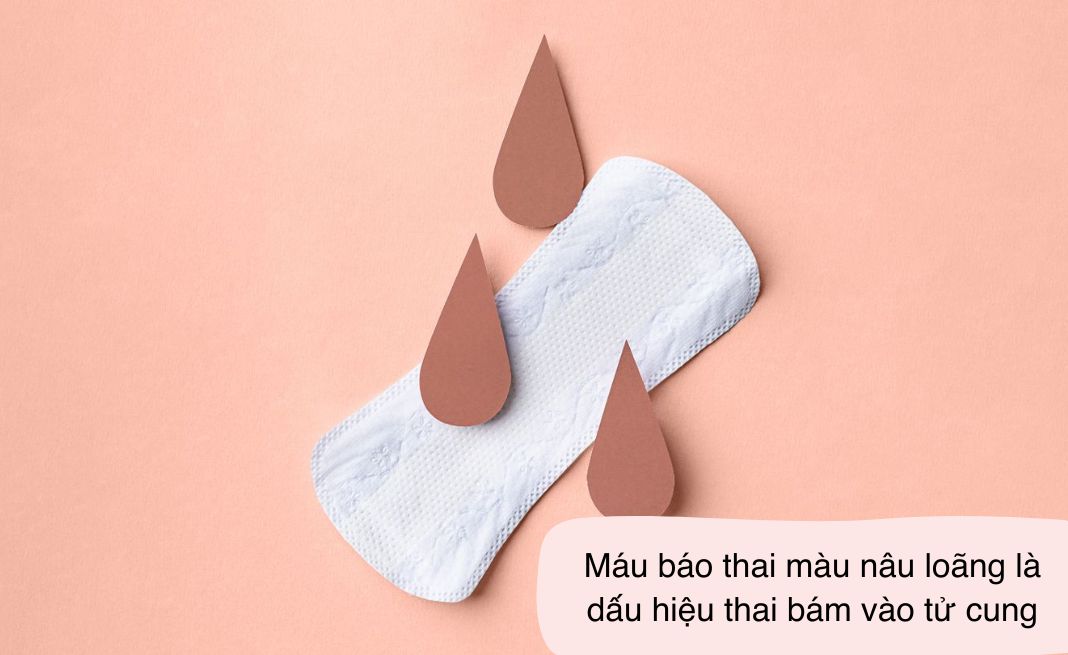 Máu báo thai màu nâu loãng là dấu hiệu thai bám vào tử cung