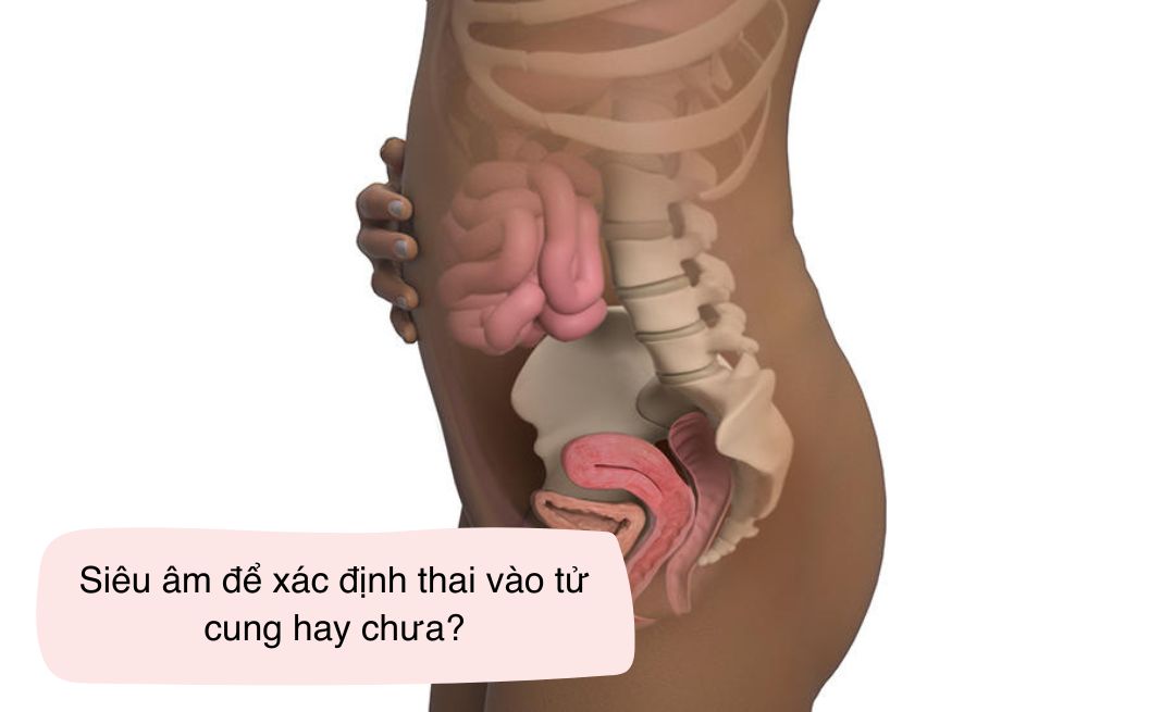 Siêu âm để xác định xem thai đã vào tử cung hay chưa