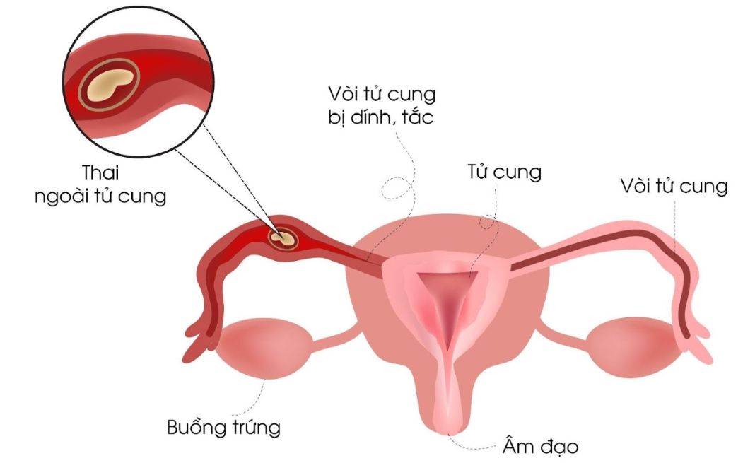 Mẹ nên đi siêu âm định kỳ để phát hiện sớm nếu bị thai ngoài tử cung