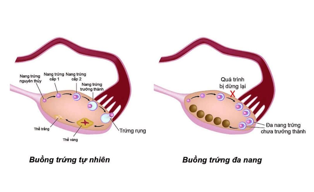 Hội chứng đa nang buồng trứng