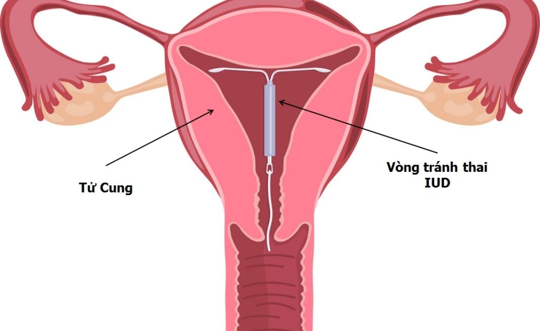 Định nghĩa về đặt vòng tránh thai