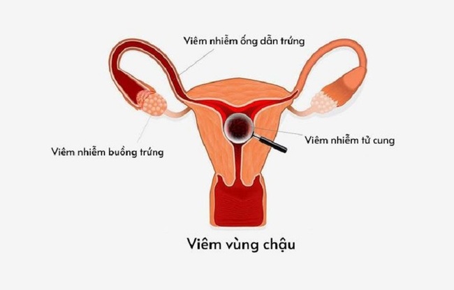 Bệnh viêm vùng chậu gây rối loạn kinh nguyệt và đau bụng kinh dữ dội