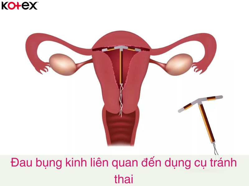 Đau bụng kinh liên quan đến dụng cụ tránh thai