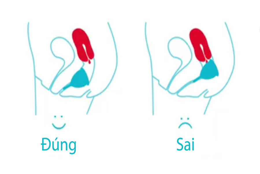 Đặt cốc sai vị trí là nguyên nhân gây đau bụng