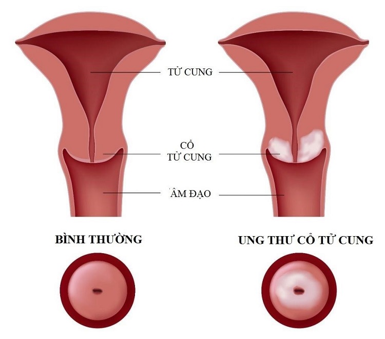 Ung thư cổ tử cung làm xuất máu nâu