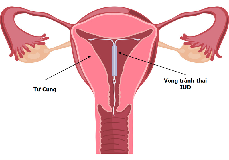 Đặt vòng tránh thai là gì?