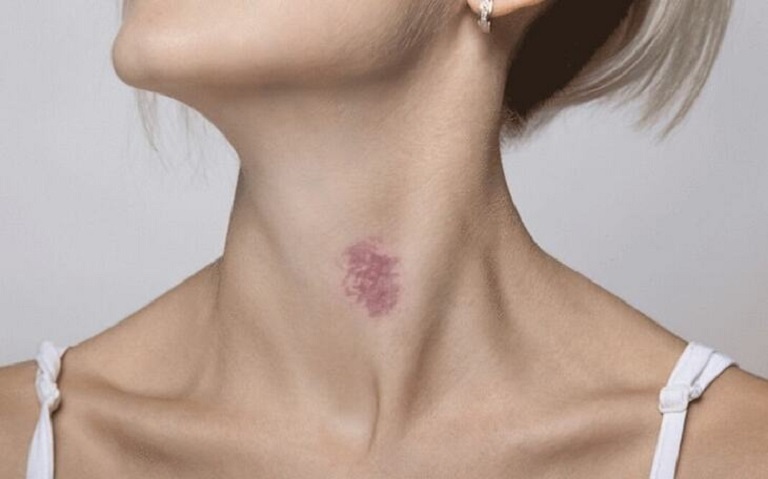 Hickey là gì