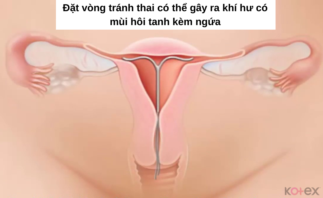 Khí hư có mùi hôi tanh kèm ngứa khi đặt vòng tránh thai