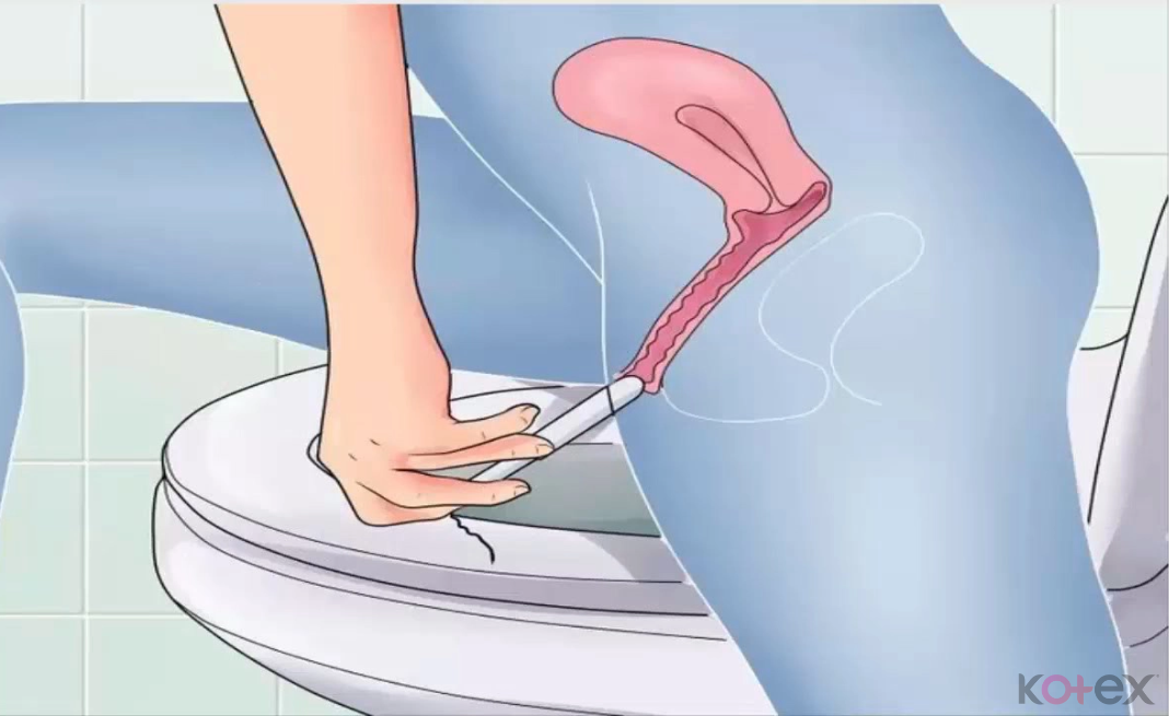 Để quên tampon trong âm đạo gây khí hư có mùi hôi thối nặng 