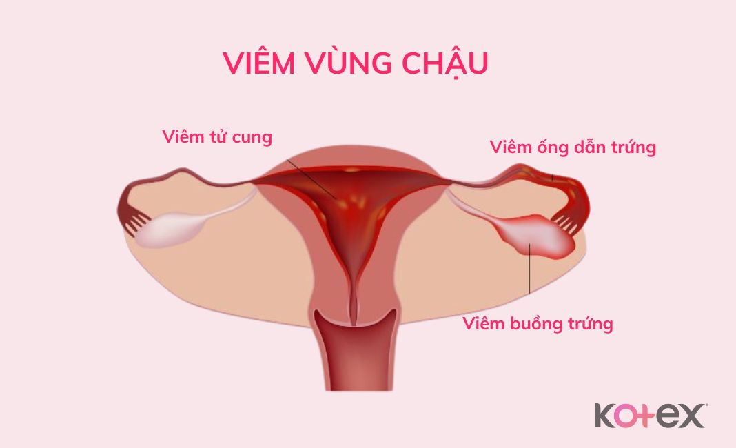 bệnh phụ khoa viêm vùng chậu