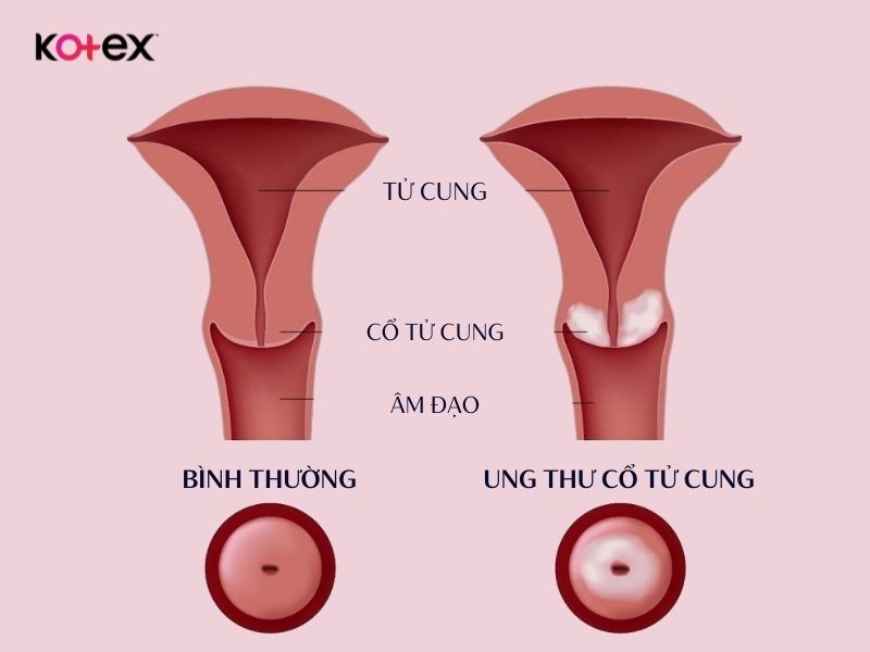 Ung thư cổ tử cung