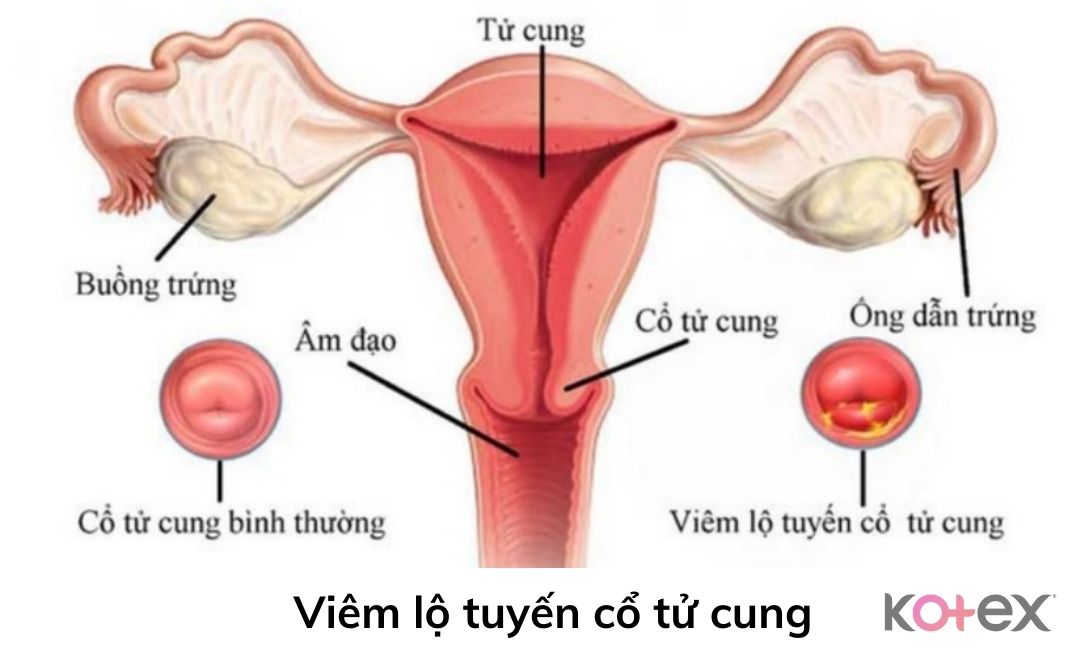 Viêm lộ tuyến cổ tử cung