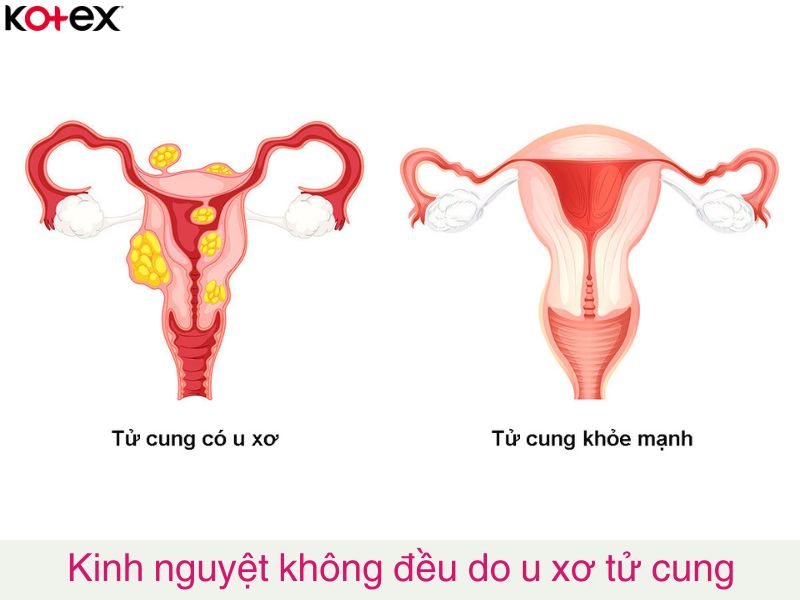 Kinh nguyệt không đều do u xơ tử cung