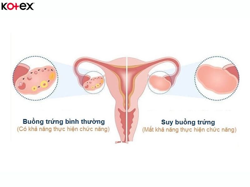 Suy giảm buồng trứng khiến kinh nguyệt bị rối loạn và máu kinh chuyển sang màu nâu