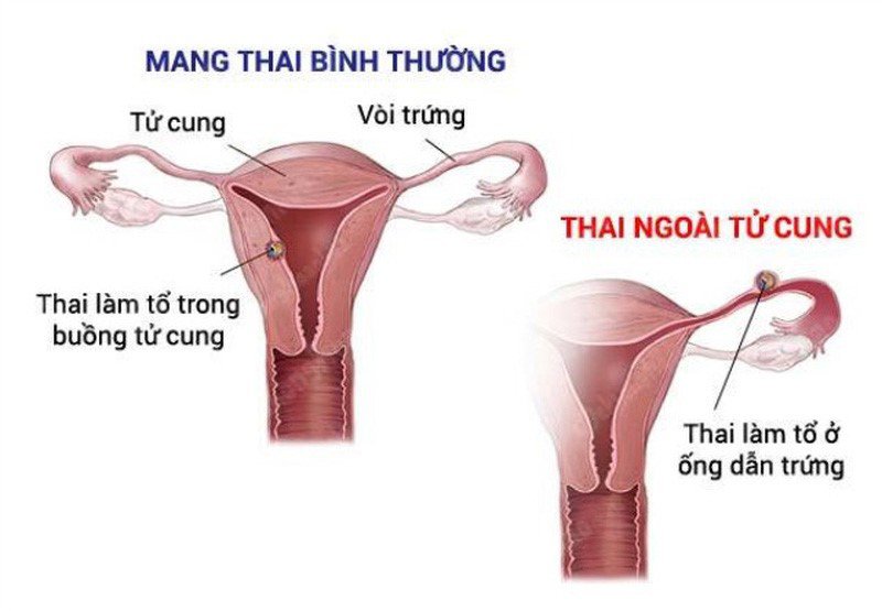 Mang thai ngoài tử cung gây nguy hiểm cho mẹ và bé