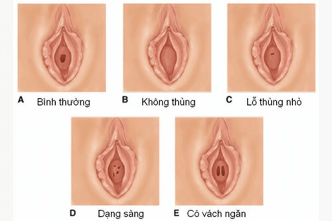 Tùy theo cơ địa mỗi người mà màng trinh thường có rất nhiều hình dạng khác nhau