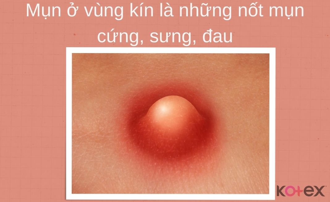 Mụn ở vùng kín là những nốt mụn cứng, sưng, đau