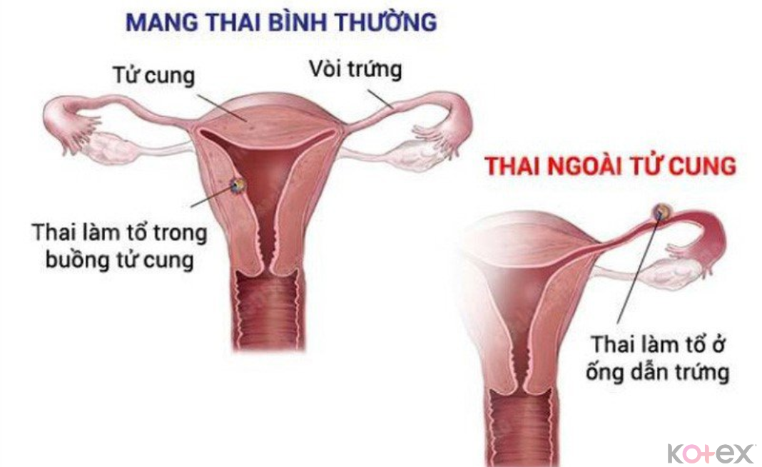 Nồng độ progesterone giảm có thể gây ra hiện tượng thai ngoài tử cung