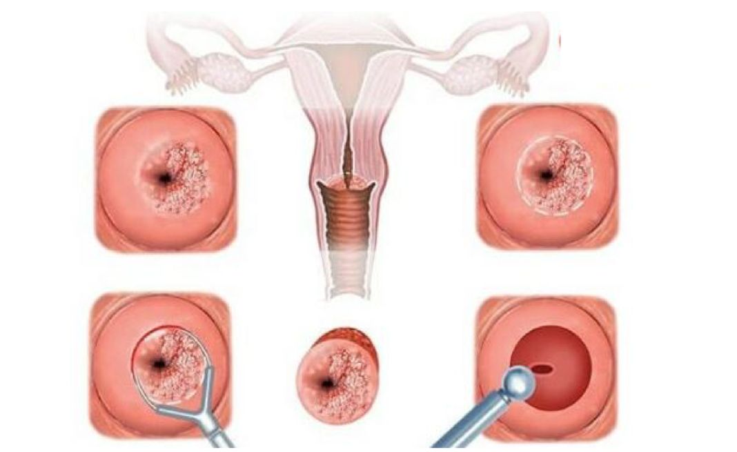 Viêm niêm mạc tử cung do quan hệ khi có kinh