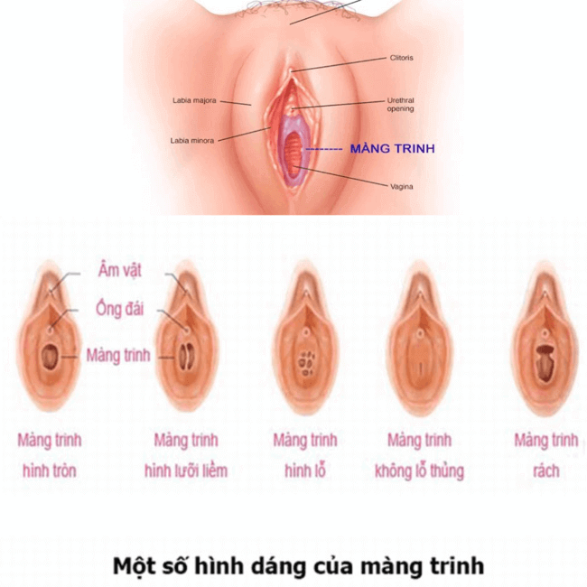 Một số hình dáng của màng trinh