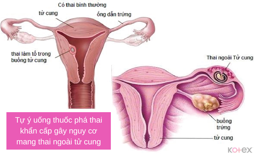 Uống thuốc phá thai không có sự chỉ định của bác sĩ có thể gây mang thai ngoài tử cung