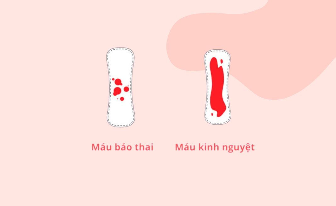 Phân biệt giữa máu kinh nguyệt và máu báo thai 