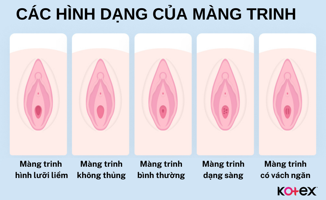 Các hình dạng của màng trinh 