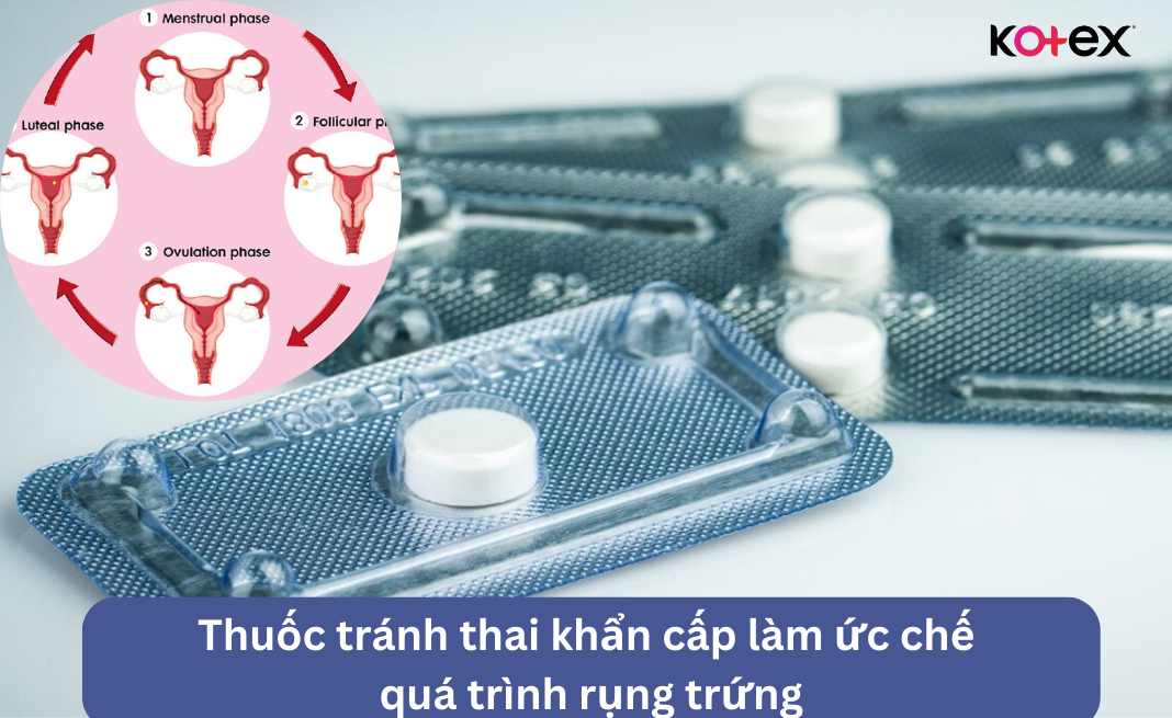 Thuốc tránh thai khẩn cấp làm ức chế quá trình rụng trứng